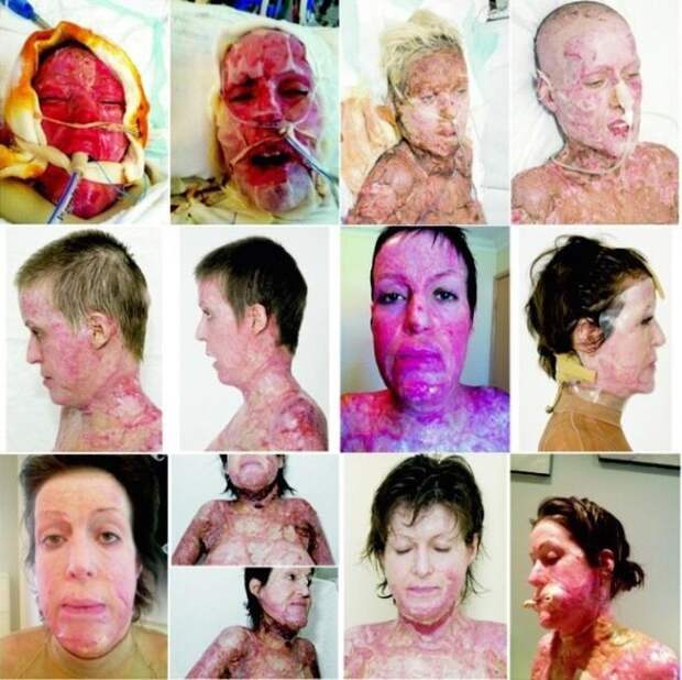 Жизнь без лица закончена: австралийка сняла маску, которую носила 2,5 года без лица, ожог