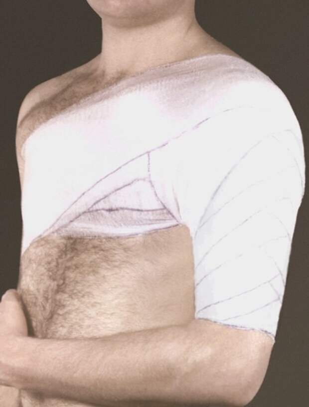 Колосовидная повязка плеча фото Медтехника