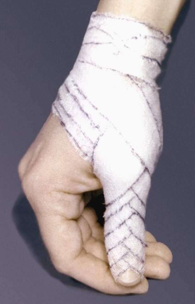 Колосовидная повязка руки фото Медтехника