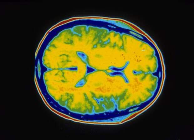 Учёные создали "карту головного мозга" для борьбы с рассеянным склерозом