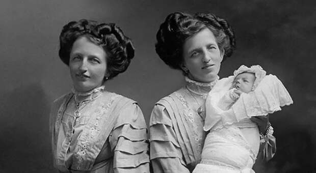 История сиамских близнецов сестер Блажек, одна из которых родила ребенка