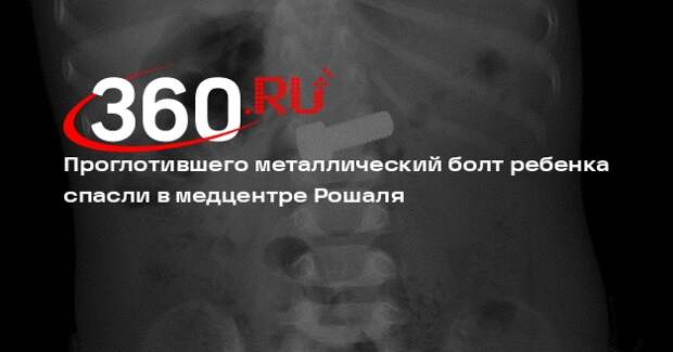 Проглотившего металлический болт ребенка спасли в медцентре Рошаля