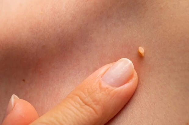 Врач Шевчук рассказал, какие папилломы могут перерасти в рак