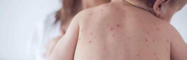 В Карагандинской области зафиксировано 278 случаев кори с начала года