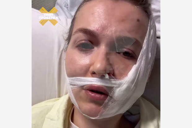 В носу россиянки вырос грибок из-за забытого врачами в ее черепе инструмента