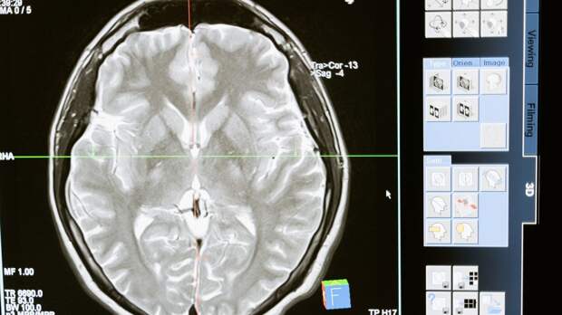 Ученые Массачусетского университета создали модель человеческого мозга для борьбы с раком