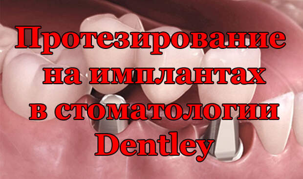 Протезирование на имплантах