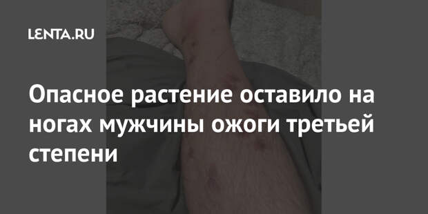 Опасное растение оставило на ногах мужчины ожоги третьей степени