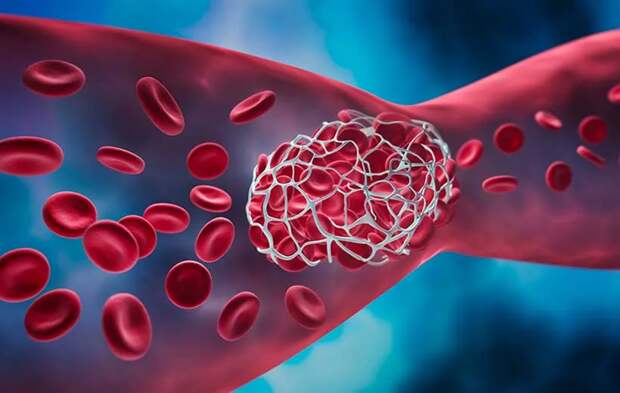 Тромбы — сгустки крови и наш защитный механизм, который обеспечивает прекращение кровотечения при повреждении кровеносных сосудов.