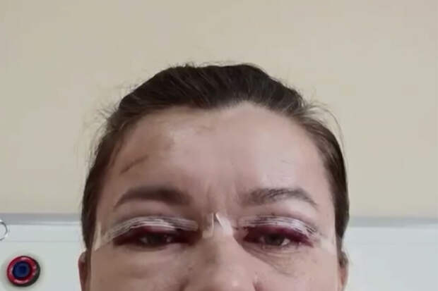 Блогерша Иришка Чики-Пики сделала блефаропластику