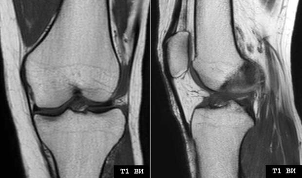 МРТ или УЗИ коленного сустава – что выбрать