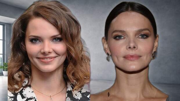 «Неузнаваемо изменились»: как пластика преобразила лица российских звёзд, и кто из них выглядит моложе на 20 лет