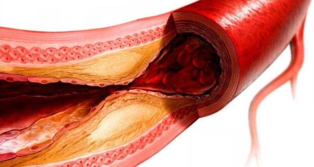 Не холестерин виноват? Ученые нашли скрытого дирижера образования бляшек в наших сосудах. И это меняет все