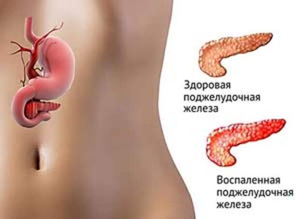 Признаки заболеваний поджелудочной