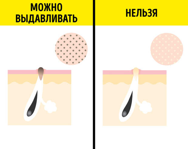 Сальные нити: от каких точек на лице НЕЛЬЗЯ избавляться Сальные нити: от каких точек на лице НЕЛЬЗЯ избавляться