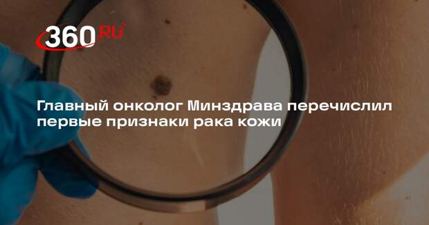 Главный онколог Минздрава: новые родинки могут быть признаком рака кожи
