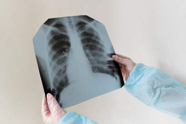 Эксперт Ким: врачи улучшили диагностику "попкорновой" болезни легких