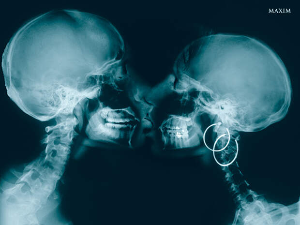 Рентген поцелуя