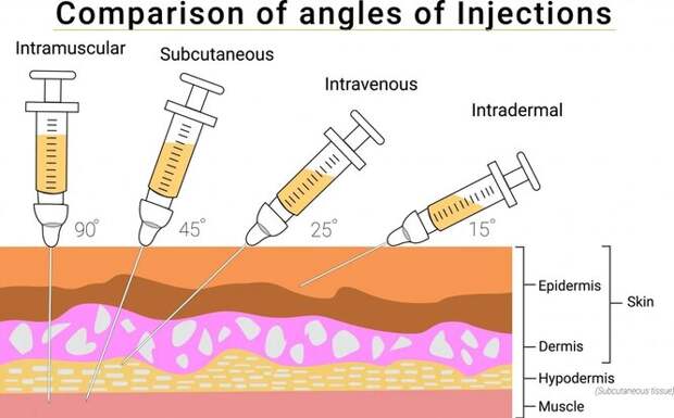 Четыре типа инъекции: внутримышечная, подкожная, внутривенная и внутрикожная инъекции