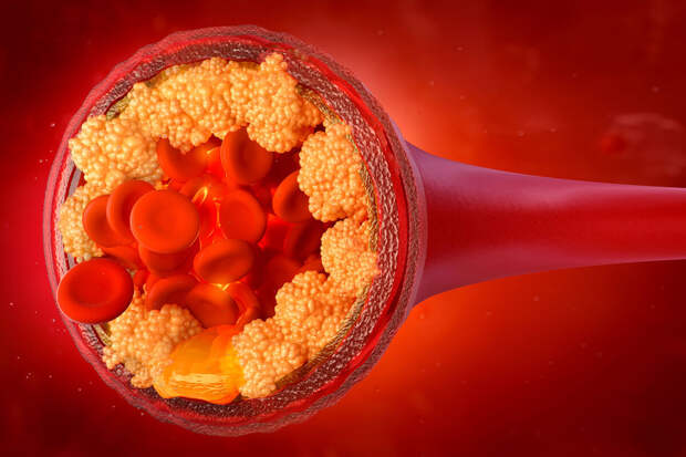 Врач Одерий: растворимая клетчатка помогает снизить уровень холестерина