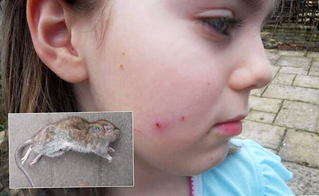 Девочка, подвергшаяся нападению крысы.