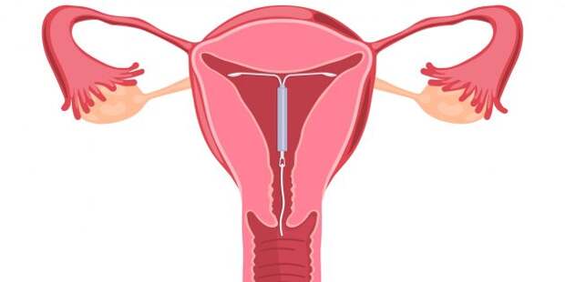Схема расположения контрацептива в матке