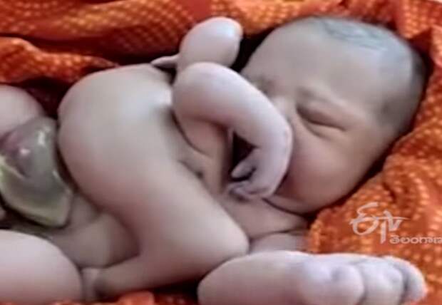 В Индии родился малыш с четырьмя руками и ногами: видео