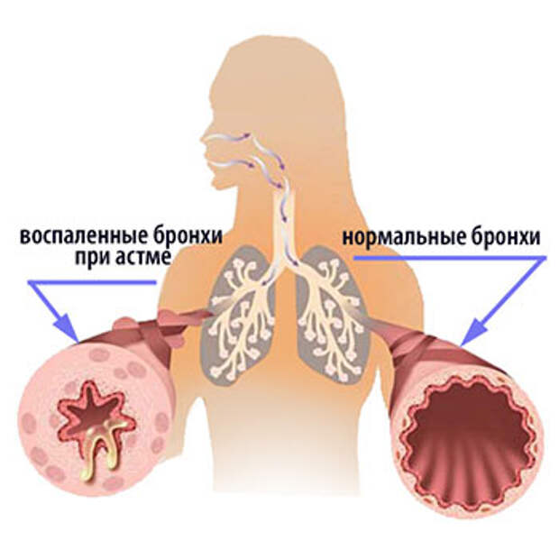 Бронхиальная астма. Фитотерапия при лечении бронхиальной астмы Лекарственные растения при бронхиальной астме