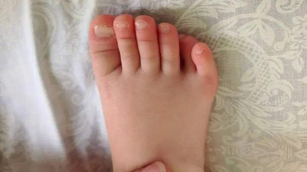 В Подмосковье травматологи удалили по одному лишнему пальцу со стоп ребенка