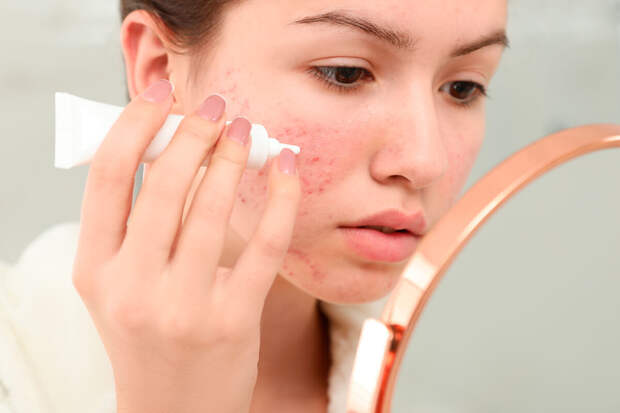 Врач Эллинский: прыщи могут указывать на инсулинорезистентность