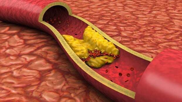 Повышенный уровень холестерина приводит к образование бляшек в сосудах