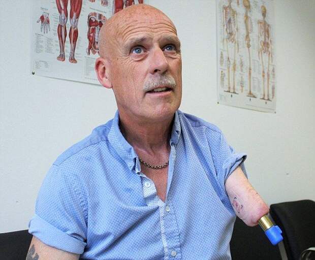 57-летнему британцу вживили бионический протез с кучей насадок