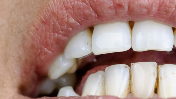 Стоматолог Лысенков: пятна на зубах могут возникать из-за кариеса
