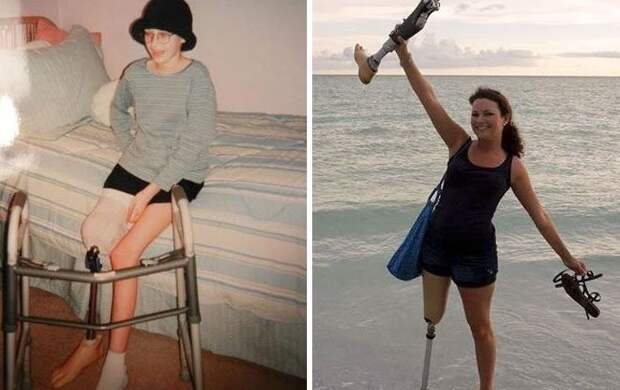 5. Фотографии с разницей в 10 лет. Десять лет без рака! вдохновляющее, выжившие, до и после, заболевание, рак, сильные духом