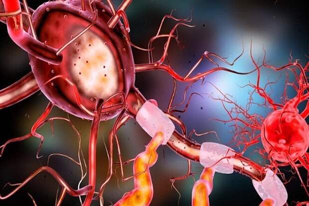23. Врождённая сенсорная нейропатия с ангидрозом