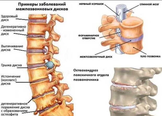 Простое избавление от остеохондроза: как муж вылечился