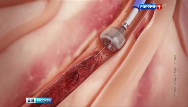 Московские хирурги спасли немецкого туриста от инсульта