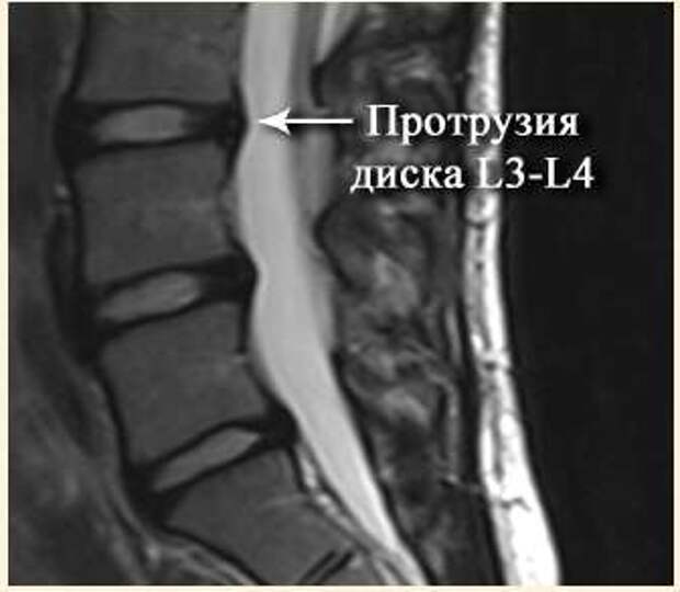 Протрузии дисков фото