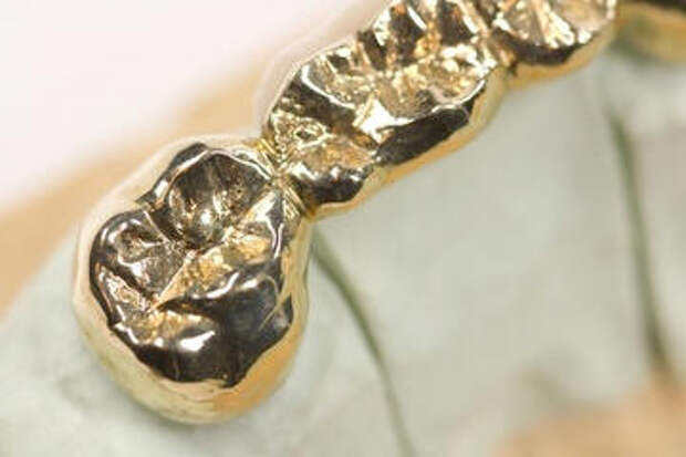 Кельты носили блестящие зубные импланты