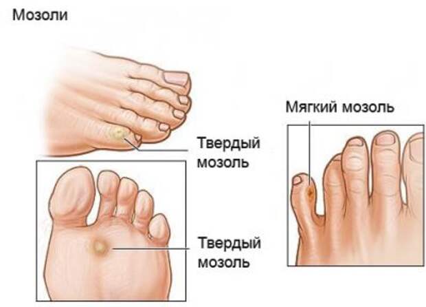 Как вылечить мозоли Народные методы лечения