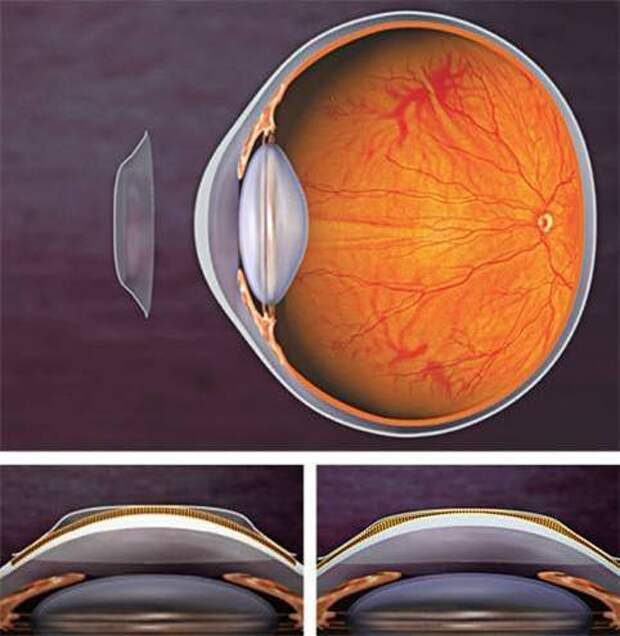 Коррекция зрения с помощью линз. Ночные ортокератологические линзы. Ортокератологические линзы мкл. Ортокератологическая контактная линза это. Исправление зрения линзами.