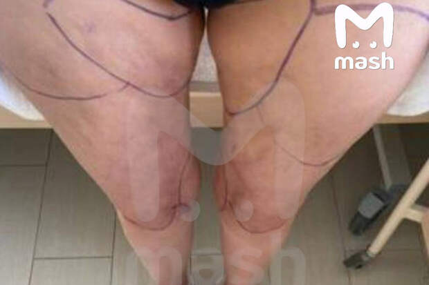 Mash: в Краснодаре у женщины начался некроз после липосакции ягодиц