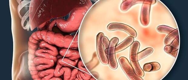Синдром избыточного бактериального роста (СИБР): Невидимая угроза для вашего здоровья