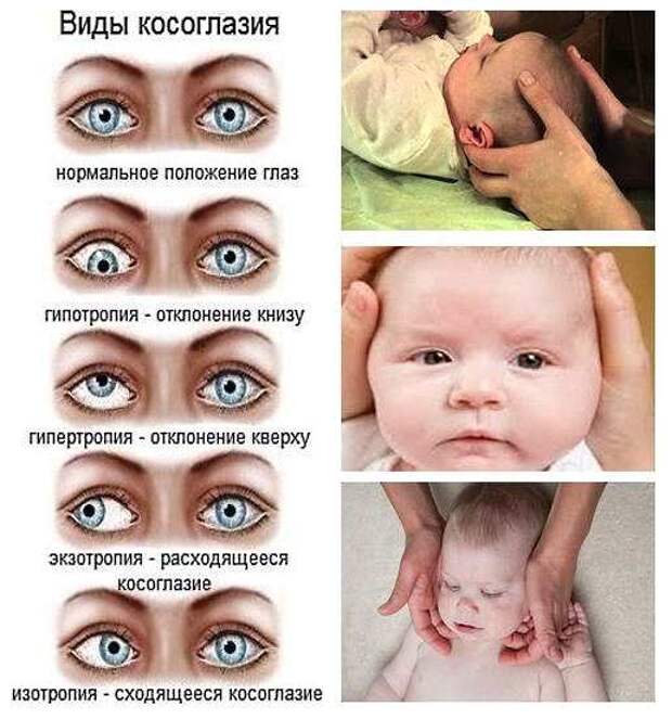 Зрение в 1 месяц. Косоглазие у детей. Глаза новорожденного. Формирование глаз у новорожденных. Косоглазие у новорожденных.