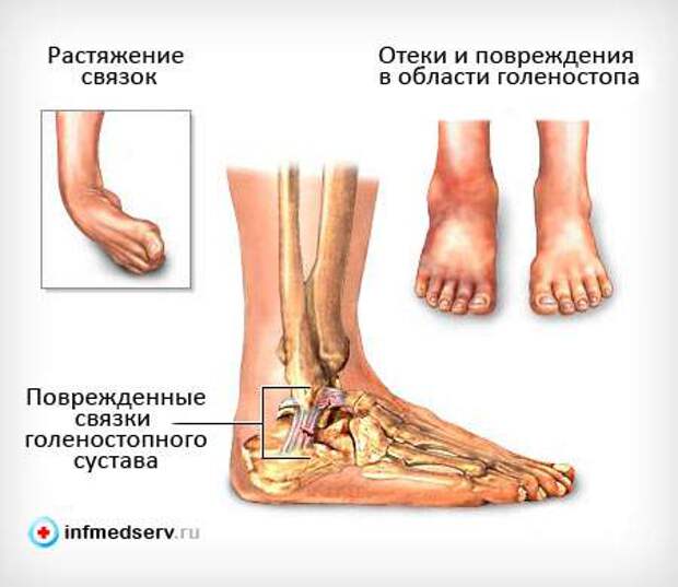 Что делать при растяжении связок? Что делать при растяжении связок?