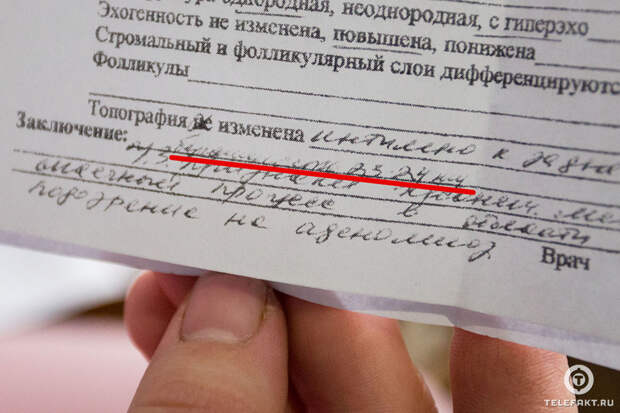 Киста, двойня