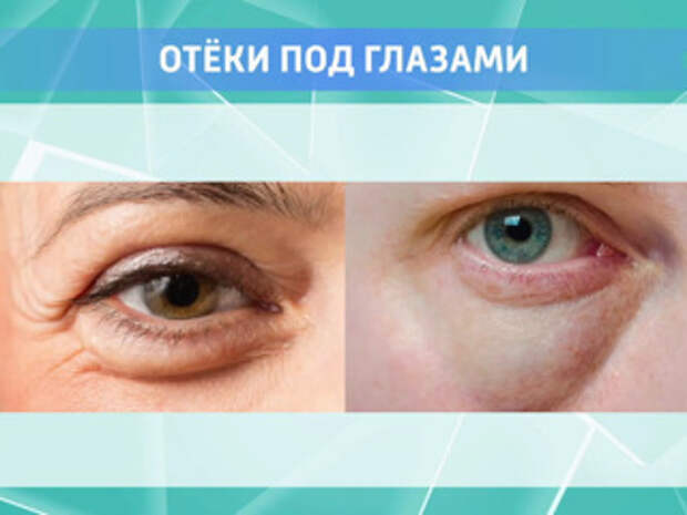 Как снять отек с глаз быстро утром. Зареванные опухшие глаза. отёки под глазами причины.