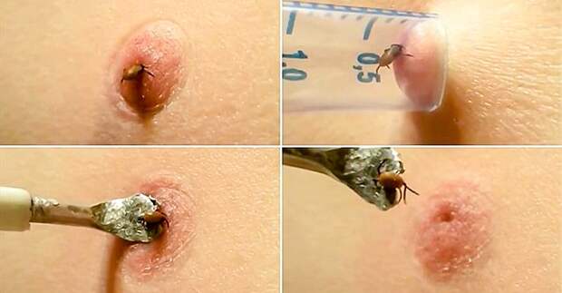 удалить клеща шприцом