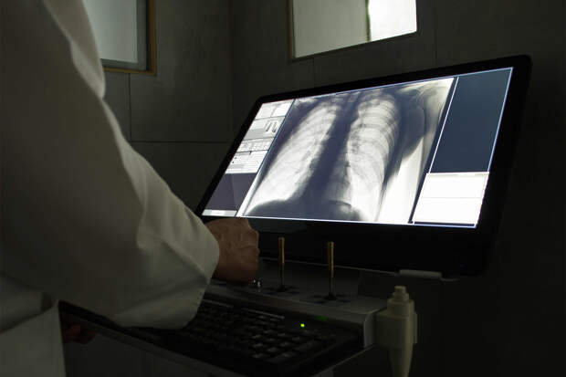 Специалист Минздрава заявил о непригодности флюорографии для защиты от рака легкого