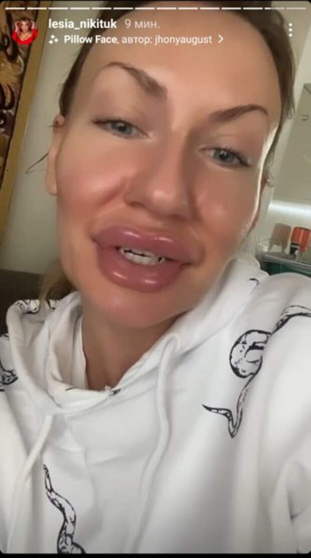 Леся Никитюк с увеличеными губами: скриншот Инстаграм-сториз